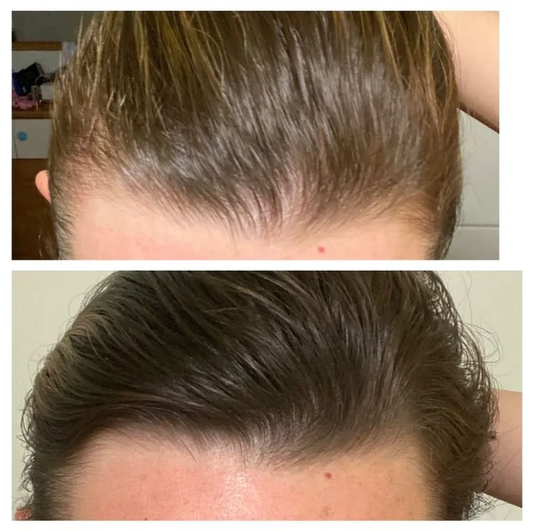Microneedling gegen Haarausfall